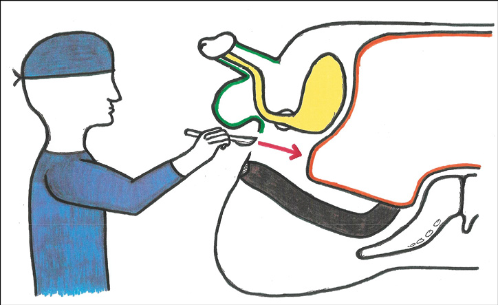 Robotics The Role Of Robotic Assisted Peritoneal Flap Augmentation In Gender Affirming